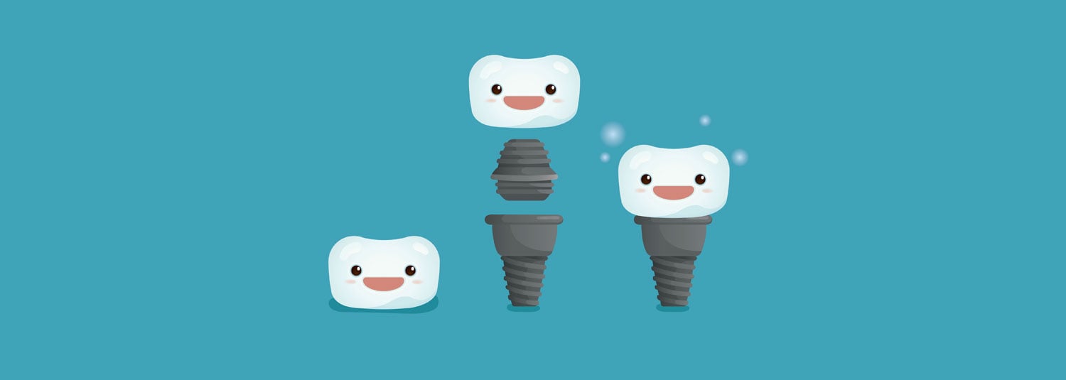 dental implant