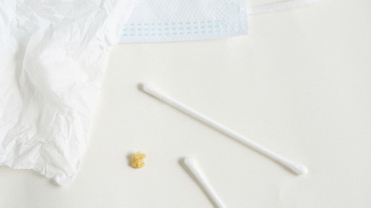 Removed tonsil stone