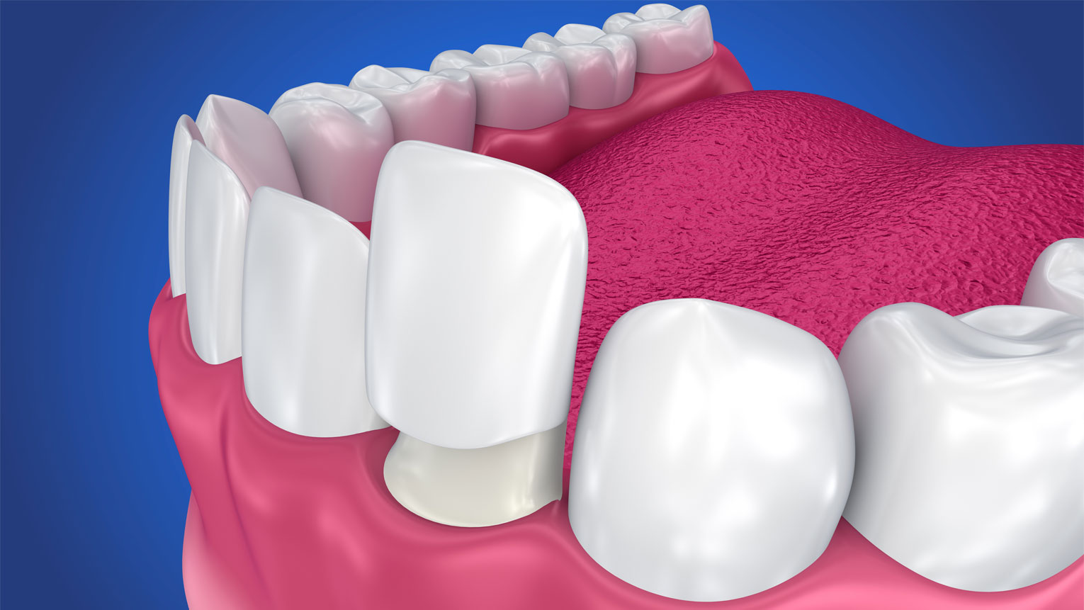 Transform Your Smile with Porcelain Veneers